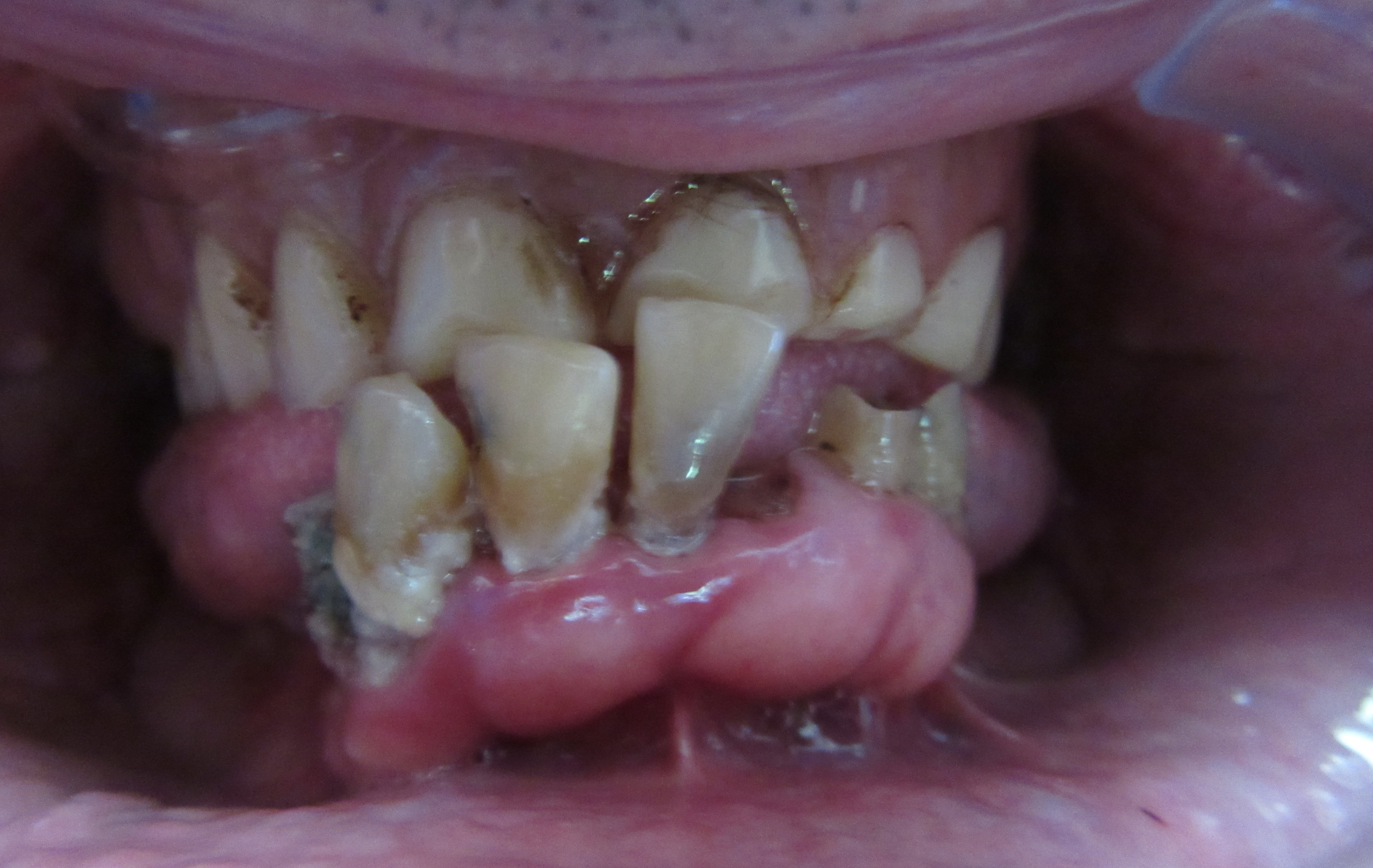 close-up of patient's teeth prior to DIEM 2