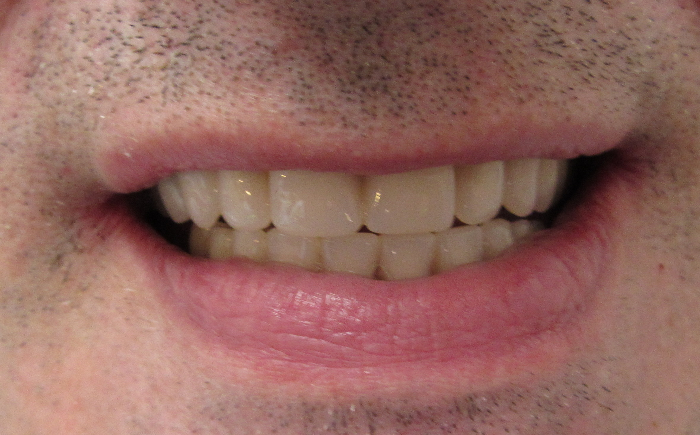 close-up of patient's teeth after same-day full arch implant supported fixed prostheses DIEM 2